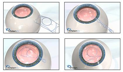 高度近视是多少度