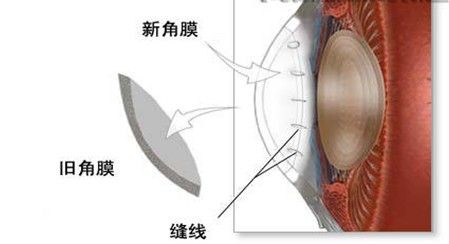 角膜移植_西安普瑞眼科医院-全国连锁