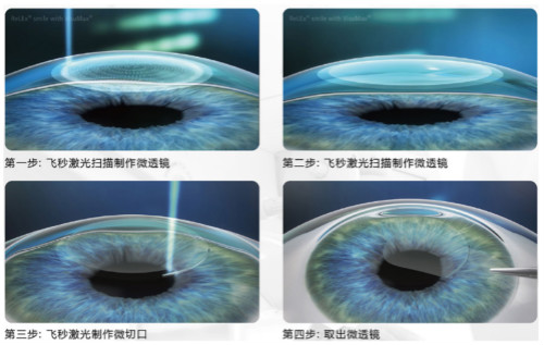 考军校视力受限?“全飞秒”跨越一步之遥