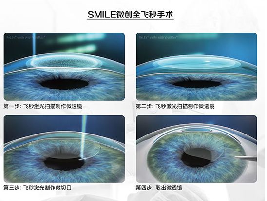 近视眼激光手术详解：全飞秒和半飞秒有什么区别？