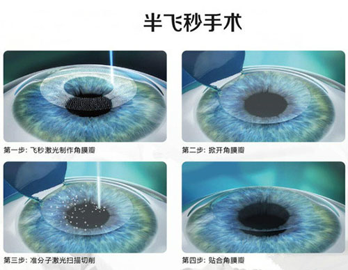 近视眼怎么恢复?普瑞眼科四大高端解决方案