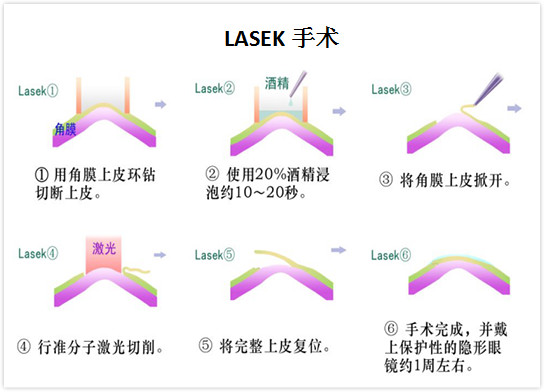 近视眼怎么恢复?普瑞眼科四大高端解决方案