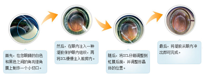 ICL晶体植入术术前术中术后注意事项