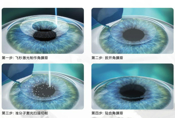 近视眼激光手术详解：全飞秒和半飞秒有什么区别？