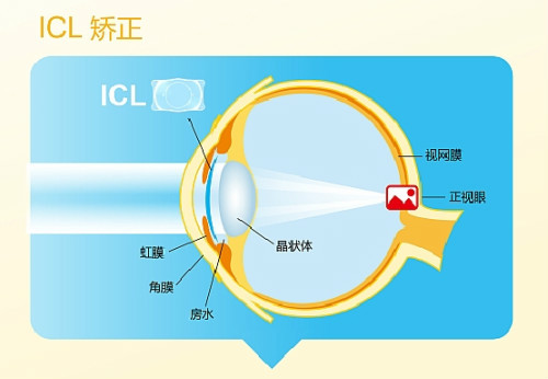 眼前有黑影？高度近视需警惕这五类并发症！